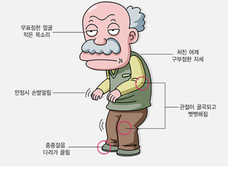 파킨슨병 초기증상 12가지 총정리 섬네일