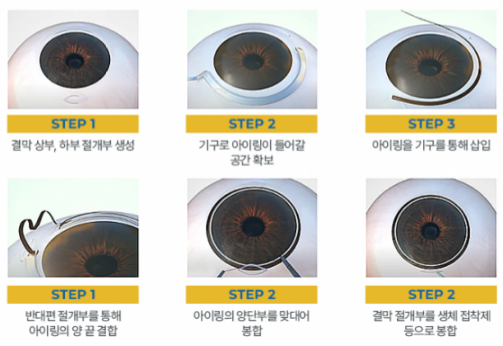아이링 수술, 눈동자 성형, 아이링 수술 가격, 아이링 수술 부작용, 아이링 수술 후기, 아이링 수술 전후 사진, 아이링 수술 회복 기간, 서클렌즈 대체 성형, 눈동자 확대 수술