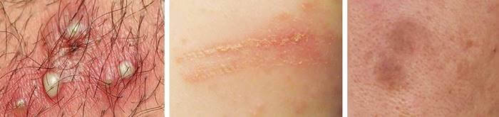 모낭염, 접촉피부염, 색소침착 3개 사진을 순서대로 보여주는 사진