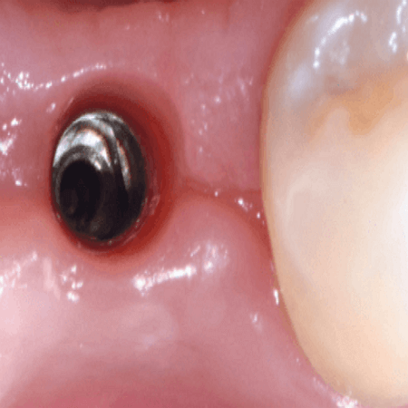 비절개로 고정체를 잇몸에 식립한 모습