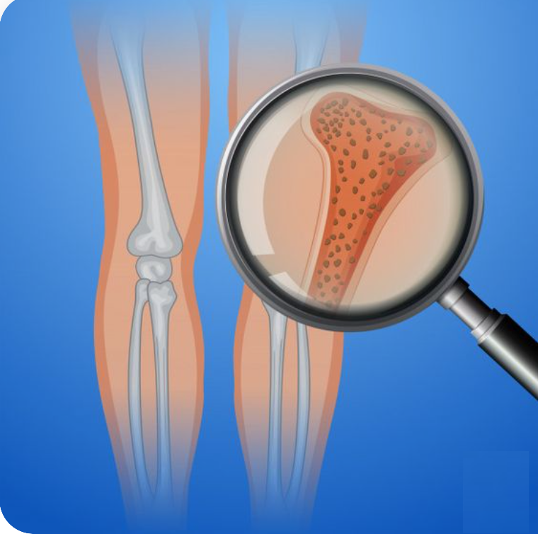 골다공증-뼈-손상