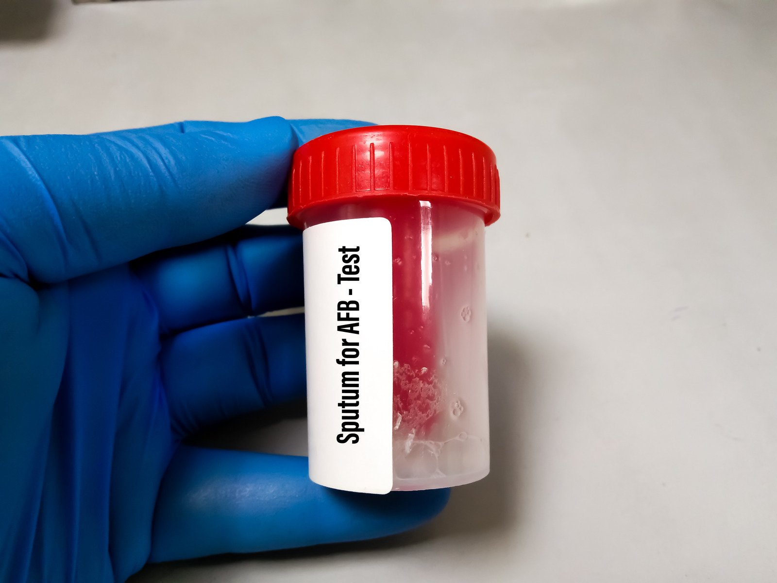 객담세포검사(Sputum Cytology Test): 폐 및 호흡기 질환 진단