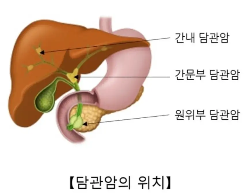 담관암의 위치