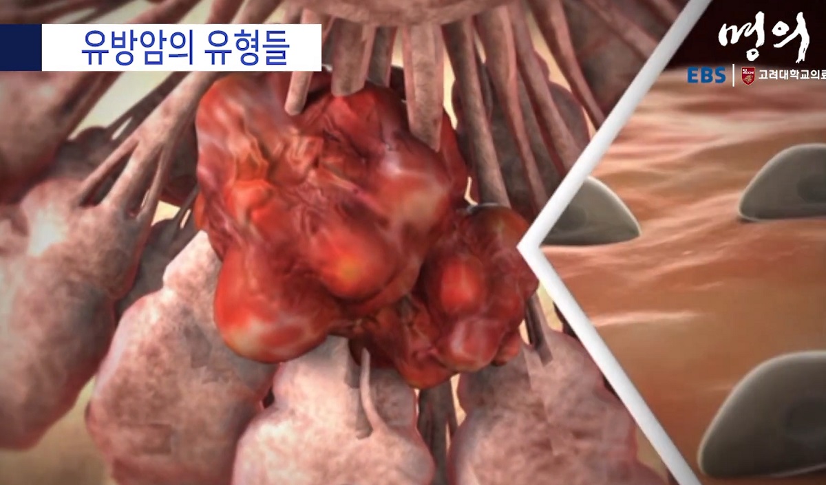 유방내분비외과-우상욱-교수