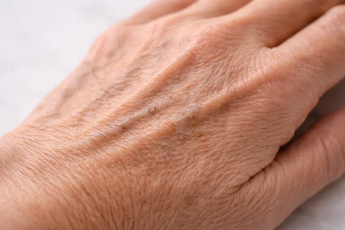 피부에 멍이 잘드는 이유