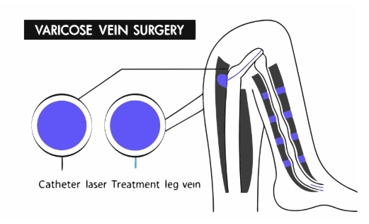 하지정맥류 수술 과정