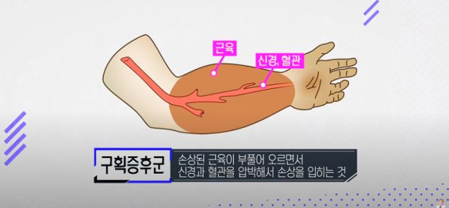 문근영 괴사 고백 '급성구획증후군' 증상 원인 골든타임 재활법 완벽 정리