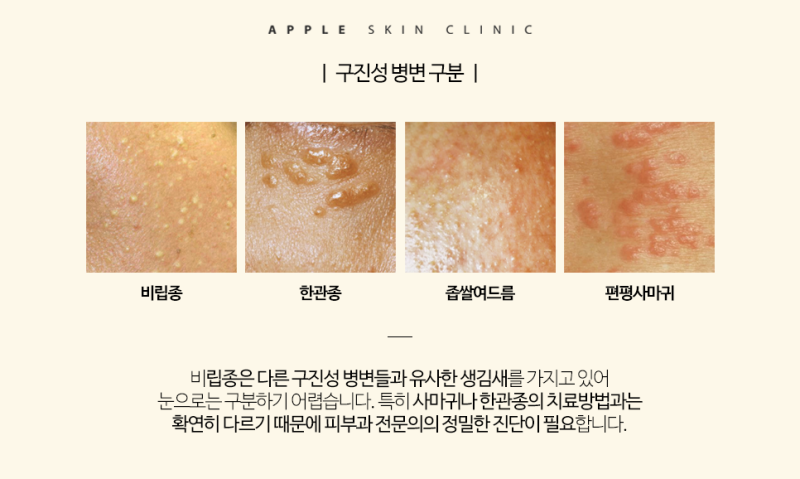 비립종 관련 이미지