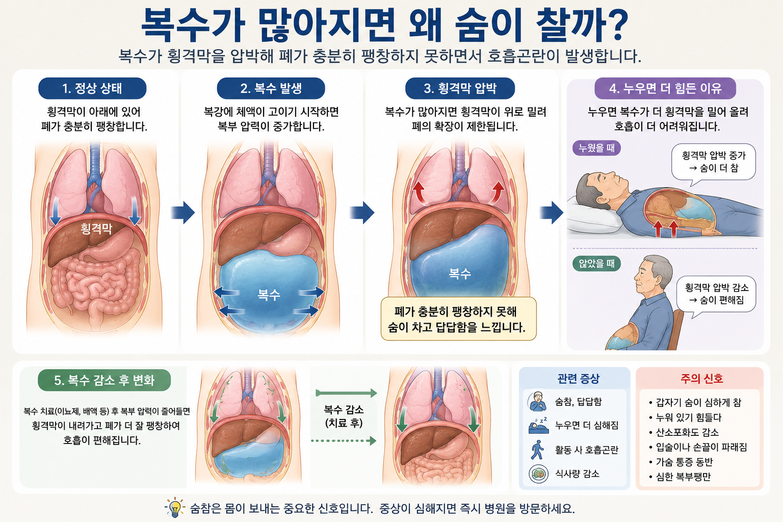 간경변 환자에서 복수가 증가하면서 횡격막이 위로 밀리고 폐가 압박되어 호흡곤란이 발생하는 과정을 설명하는 의료 인포그래픽 이미지
