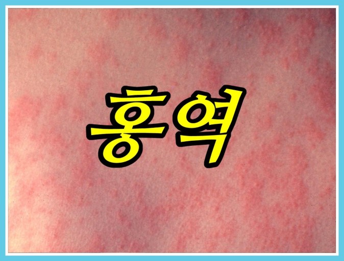 "홍역"이 난 피부 모습