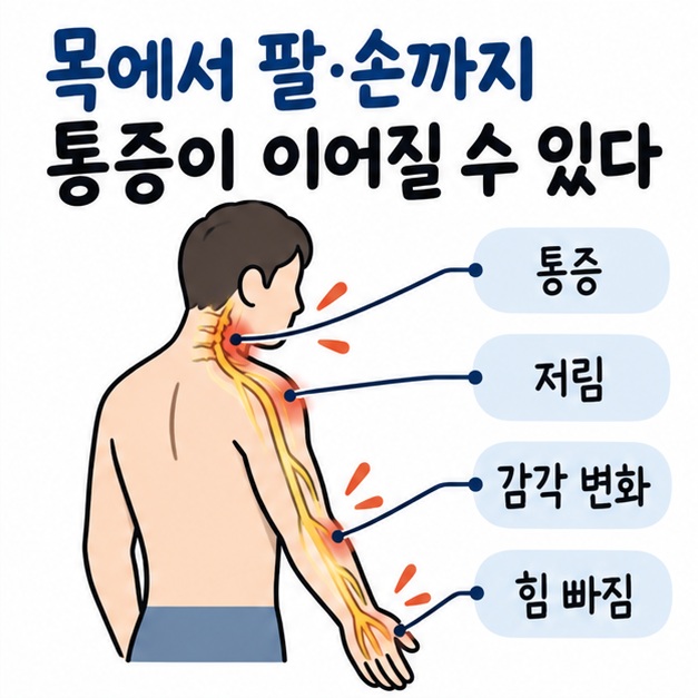 목에서 어깨와 팔, 손 쪽으로 통증과 저림이 이어지는 경로를 보여주는 카드