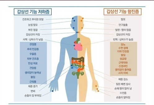 갑상선의 기능 항진증과 저하증 비교 관련 이미지