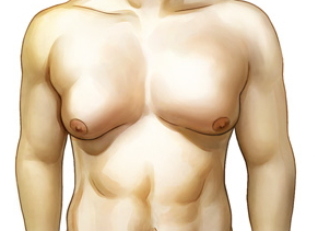 남성여유증 치료 과정