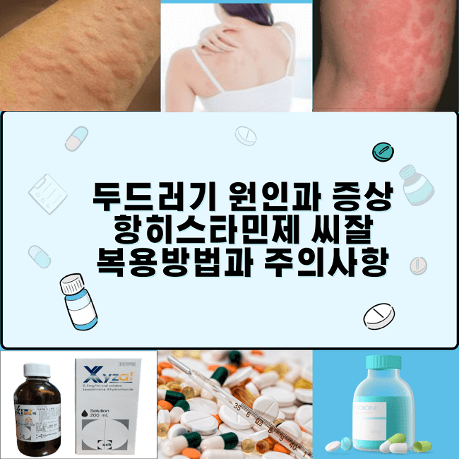 두드러기-원인과-증상-및-종류-항히스타민제-복용방법과 주의사항=썸네일