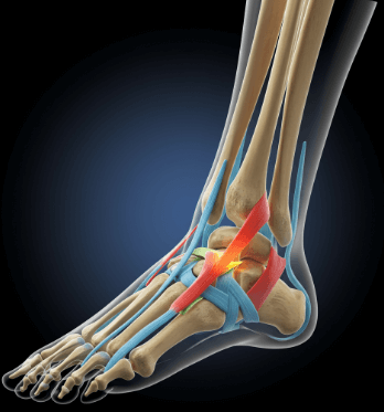 발목 통증 원인과 치료방법4