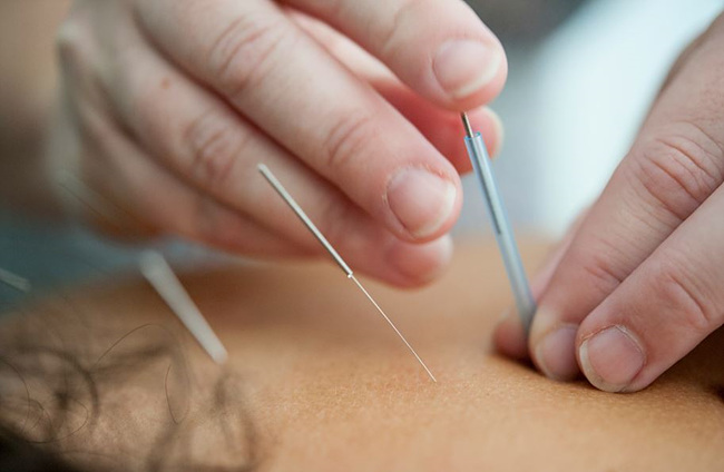 한의원에서 얼굴에 침을 맞는 사진