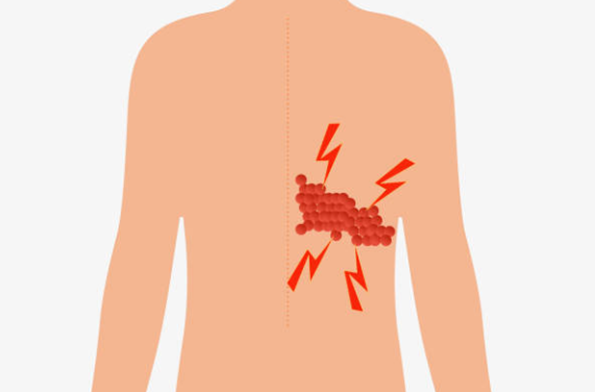 대상포진-증상-모양