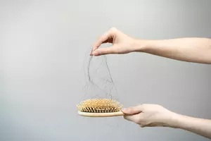 두피 지루성 피부염