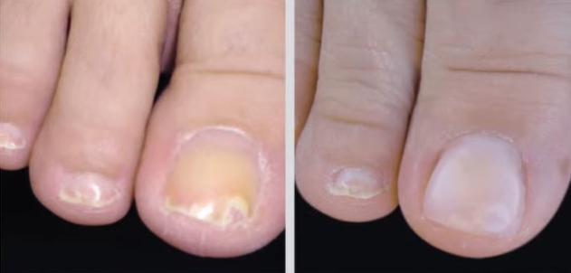 발톱이 검게 변하는 이유