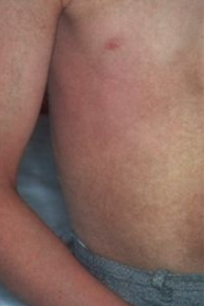 어린선 복부 증상