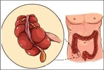 맹장은 어디에 있고 어떤 모양일까