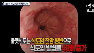 역류성 식도염 증상 5가지