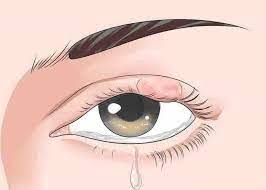 눈다래기 원인