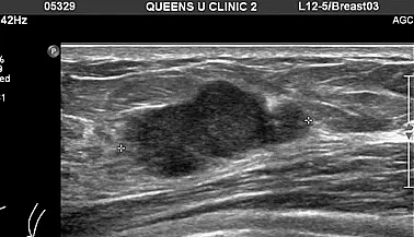 유방암 초기증상