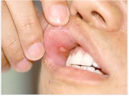 입안이 자주 허는 이유