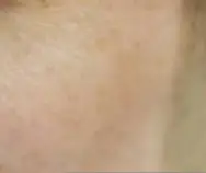 녹내장 초기 증상 &mdash; 시야를 서서히 빼앗는 침묵의 질환