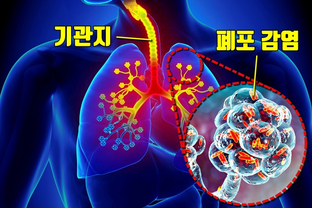 폐렴 증상,폐암