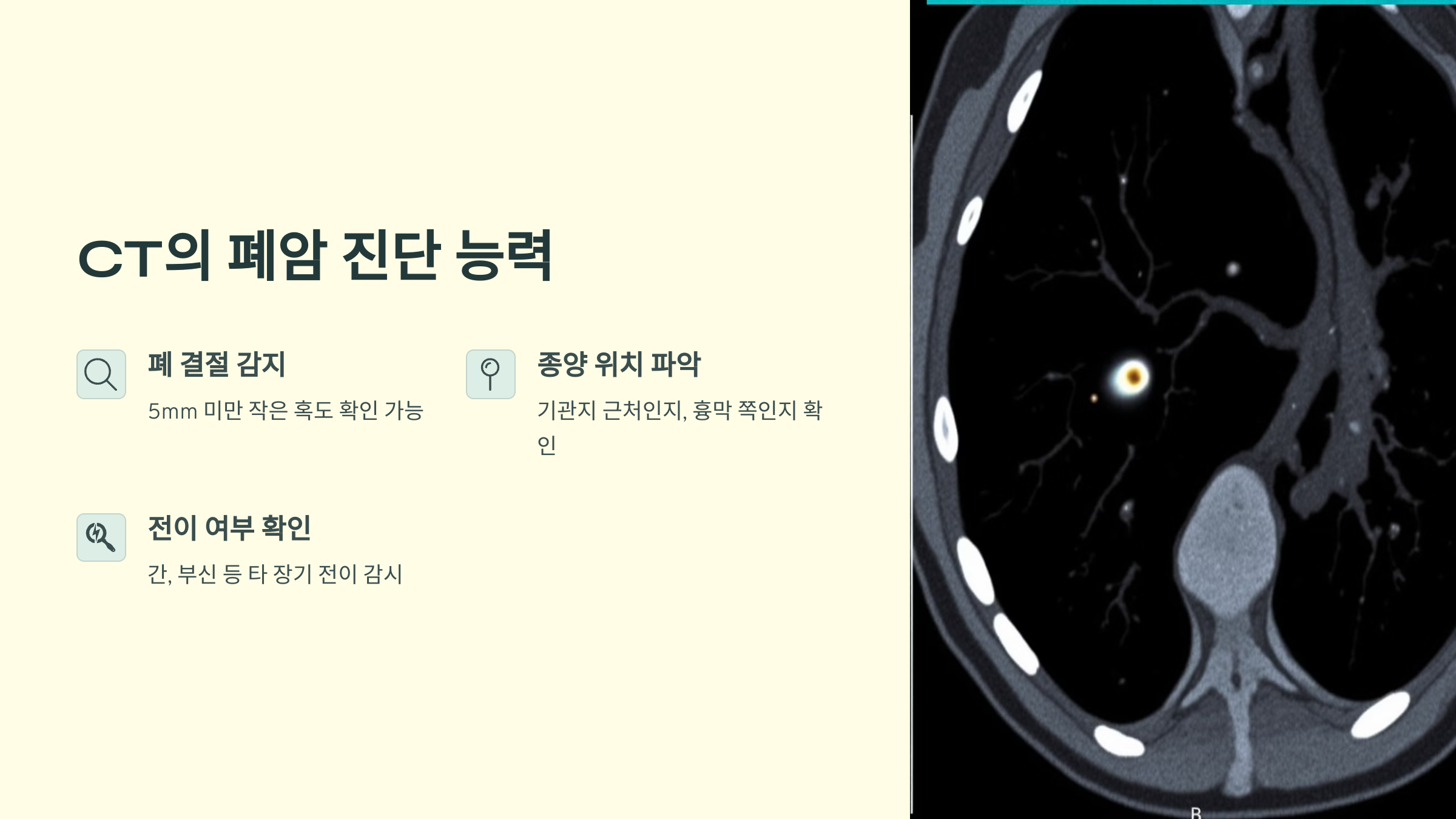 CT의 폐암 진단 능력