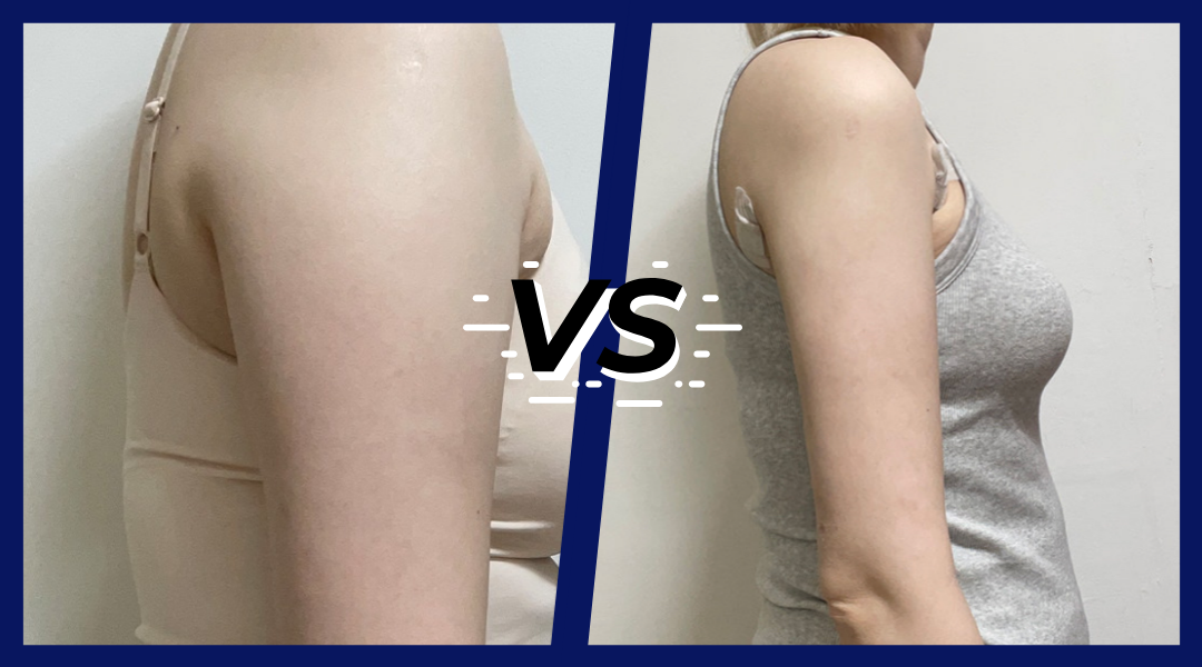 경과 한달 후 비교사진 옆모습.