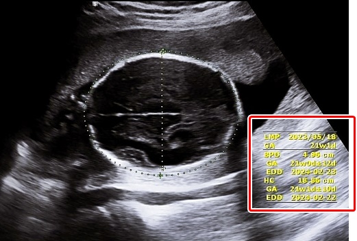 초음파사진21주