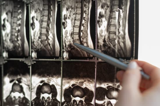 척수 손상(Spinal Cord Injury): 원인, 증상 및 치료법