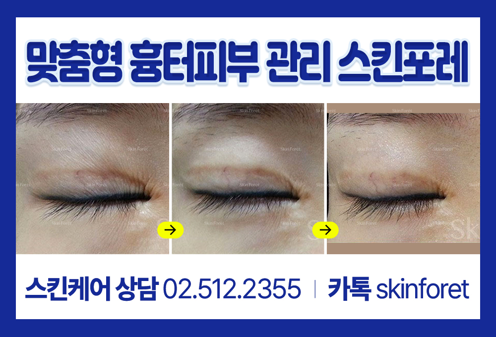 앞트임 후 생긴 세로주름과 눈밑세로주름, 눈앞트임 관리 스킨포레
