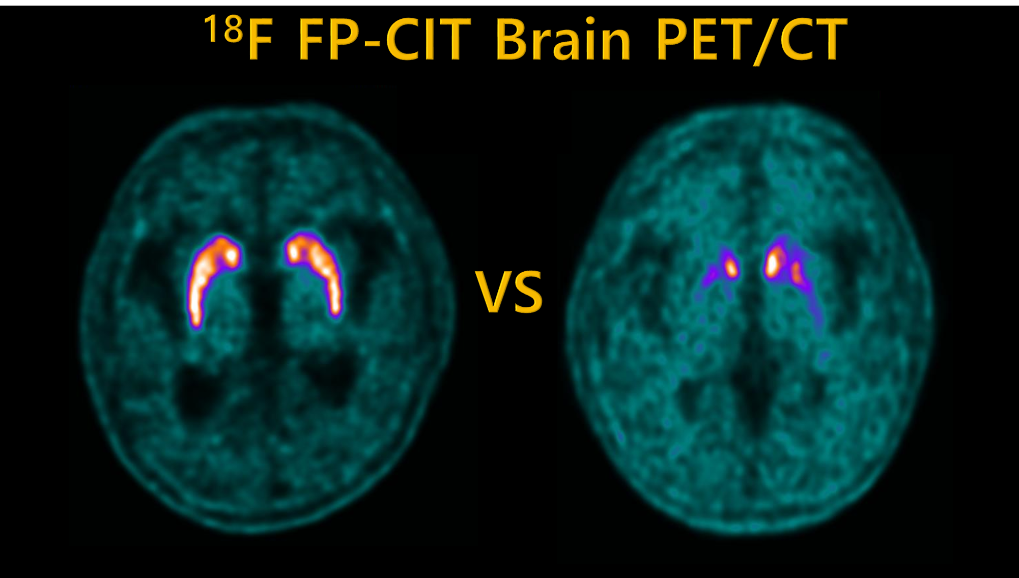 PET/CT를 이용한 뇌 선조체 영상. 파킨슨병의 경우 선조체에 방사성의약품 섭취가 감소하는 경향이 나타난다.