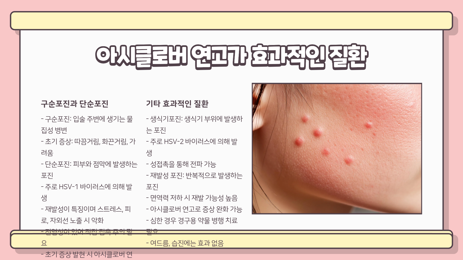 아시클로버 연고 효능 총정리 ❘ 아시클로버 연고 부작용과 가격까지 제대로 알아야 하는 이유
