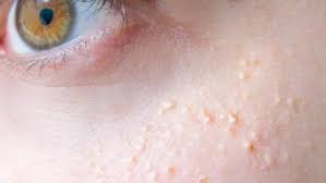 수질 오염으로 인한 피부 트러블