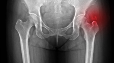 고관절 이미지