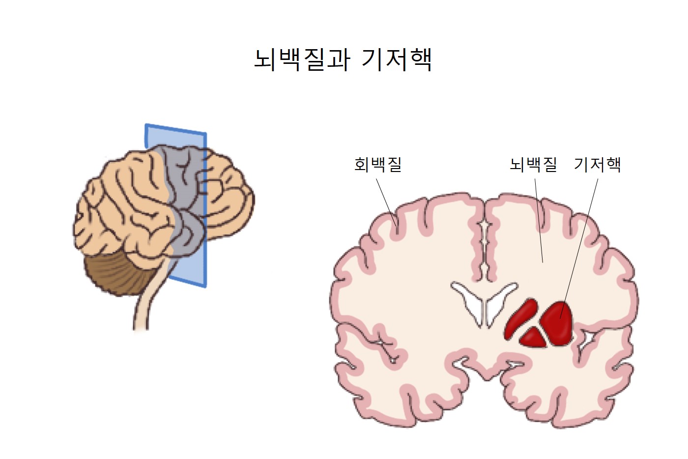 신경퇴행질환 할러포르덴-스파츠병