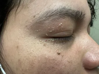 비립종 생기는 이유 비립종 없애는 방법 피부 관리법_7