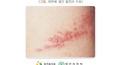 대상포진이미지