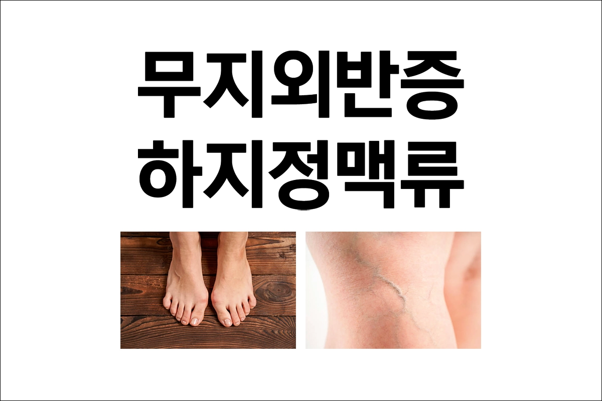무지외반증과 하지정맥류 예방 발 건강 지키는 법