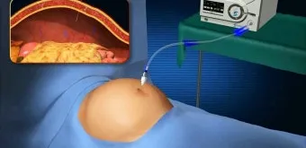 배에 가스가 차고 방귀를 자주 뀜 원인부터 해결책까지 한번에 알아보기_12