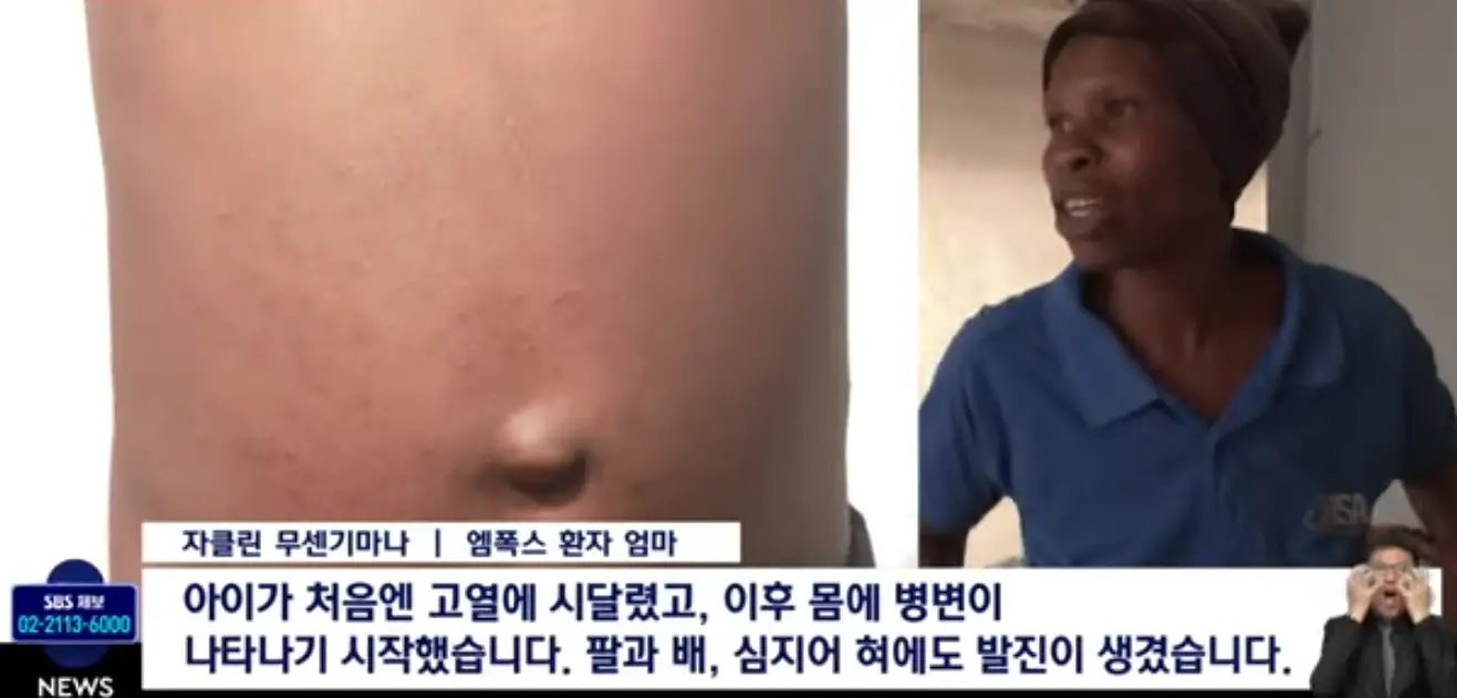 엠폭스