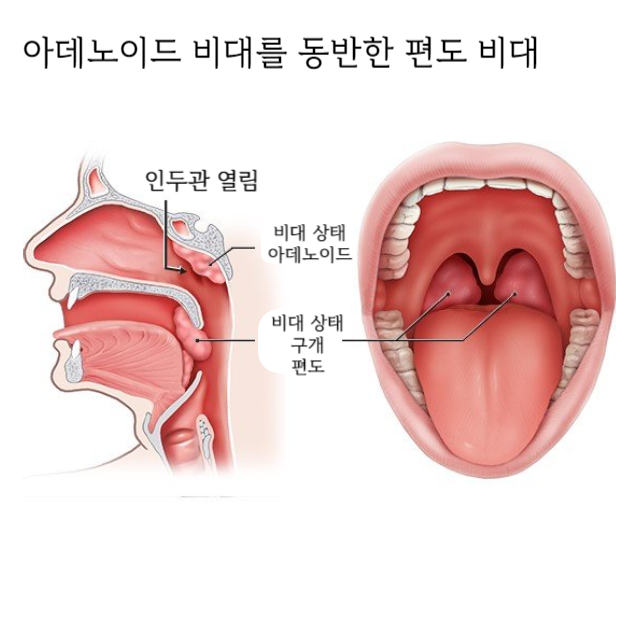 편도염