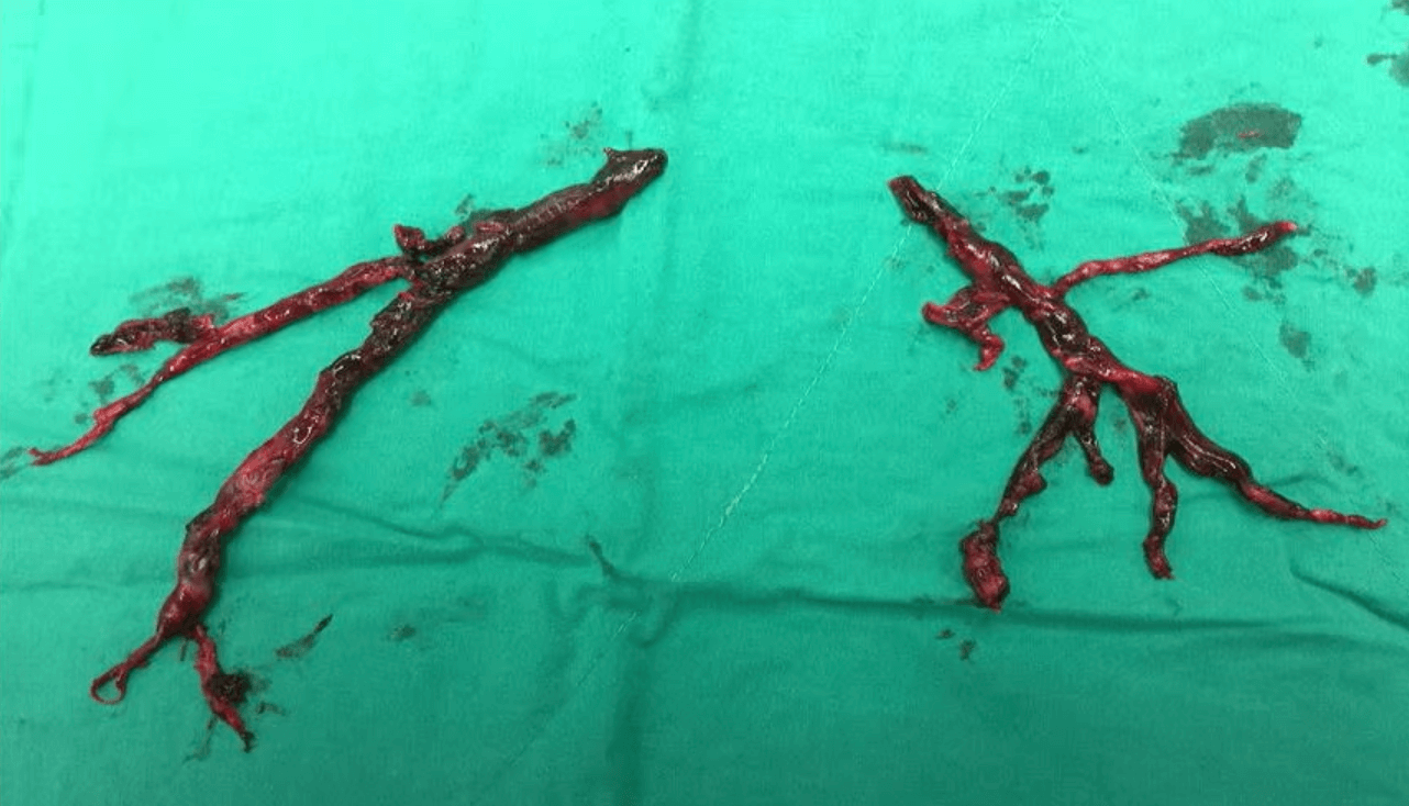 수술로 제거된 혈전