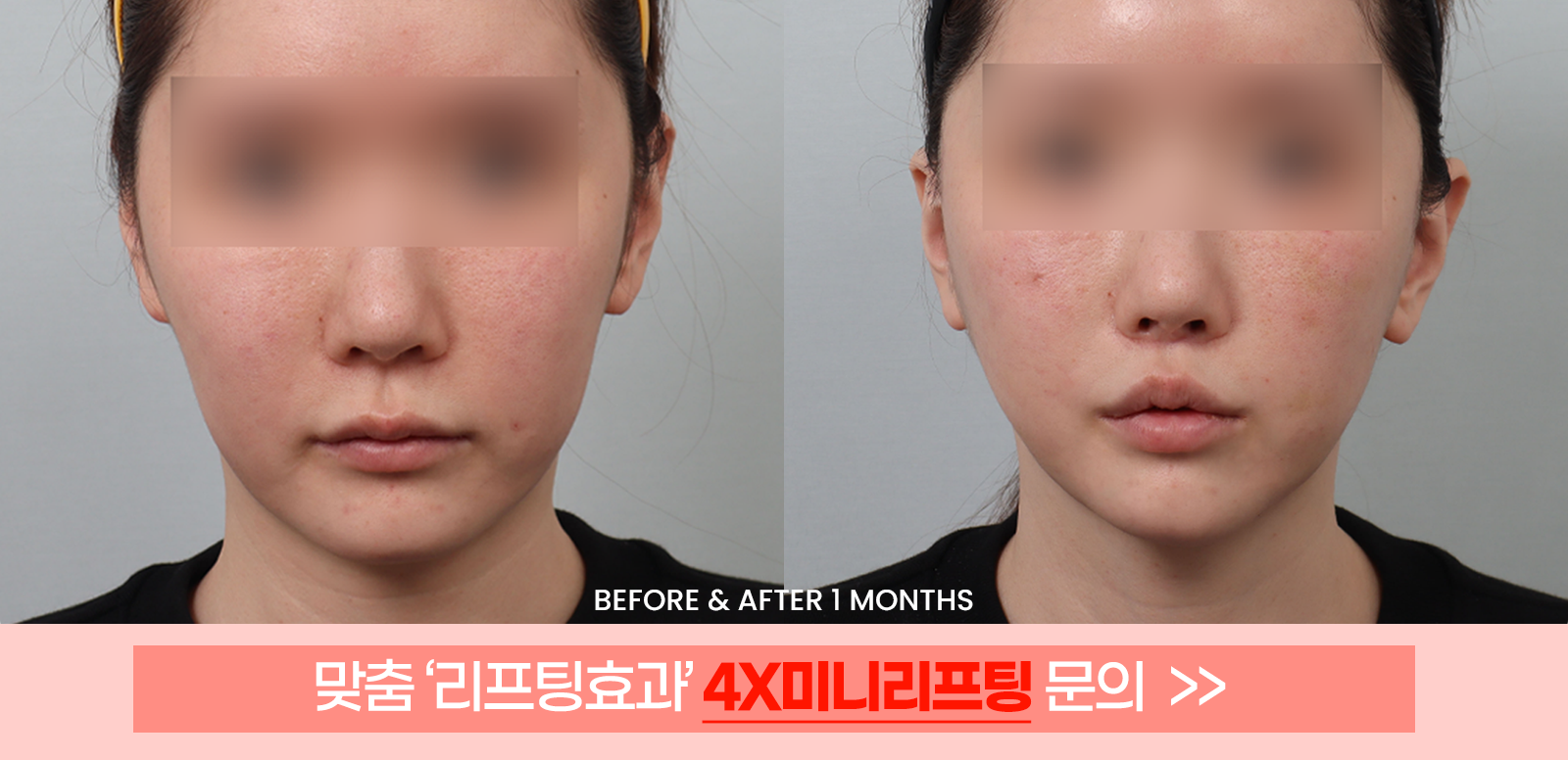 남자리프팅