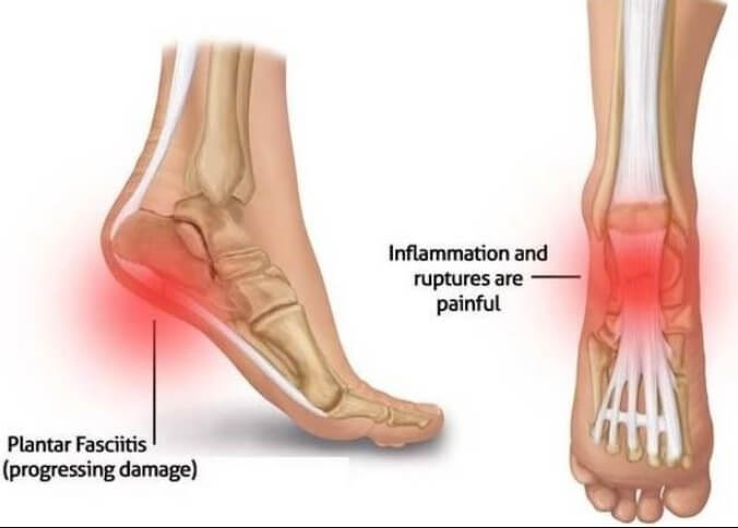 족저근막염 진단 예방 치료 알아보기
